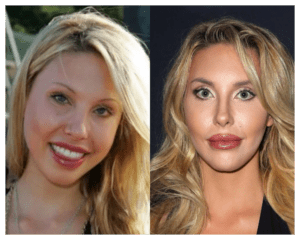 Chloe Lattanzi Before After Plastic Surgery Pictures