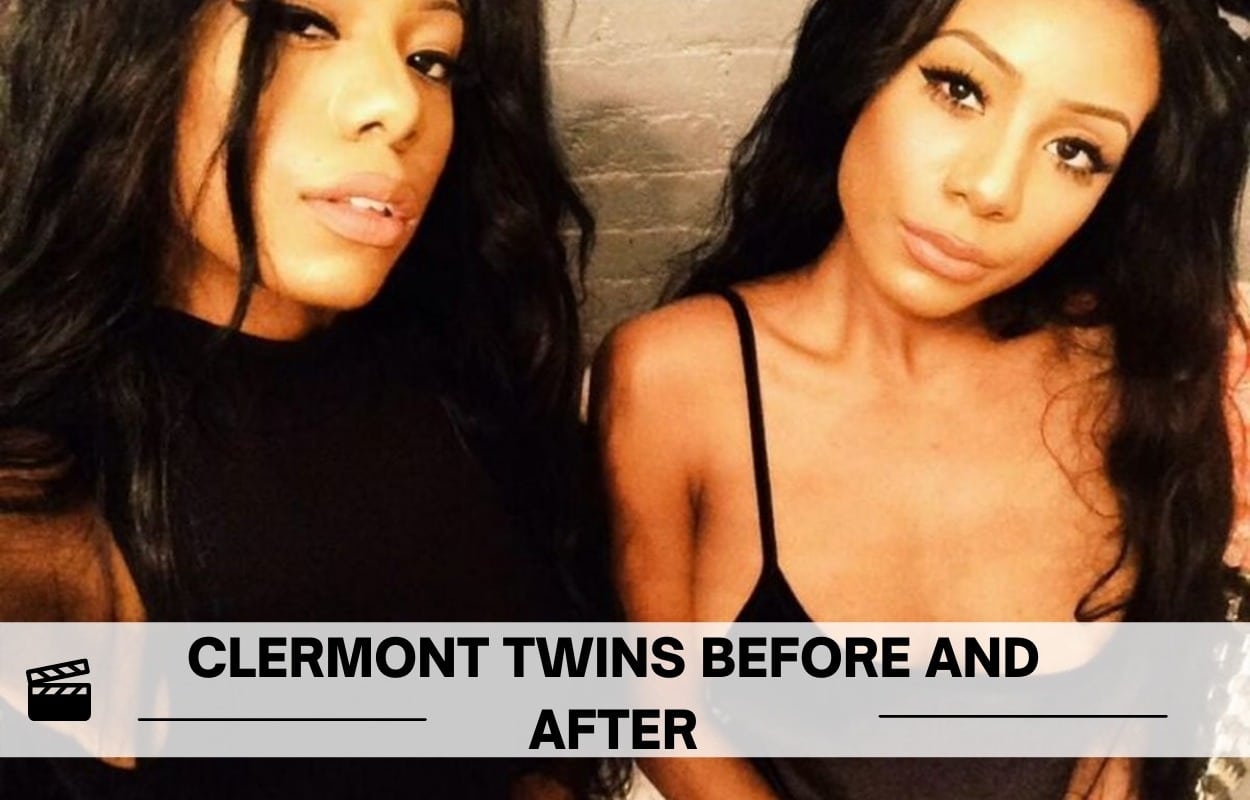Clermont Twins Before And After Buttocks, Cheek, Chin, And Lips Surgery Photos