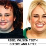 Rebel Wilson Teeth before and after