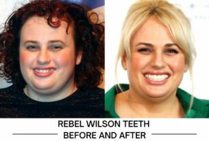 Rebel Wilson Teeth before and after