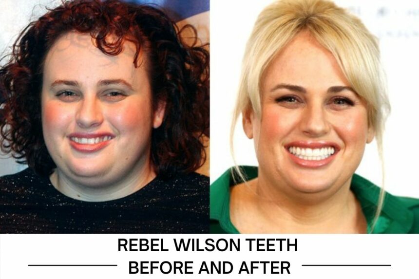 Rebel Wilson Teeth before and after