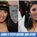 cardi b teeth before and after