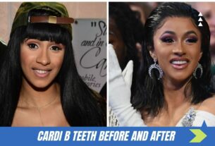 cardi b teeth before and after