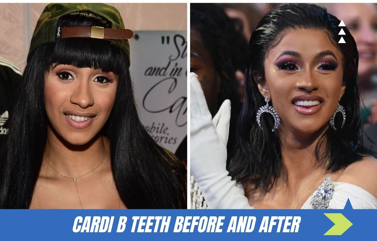 cardi b teeth before and after