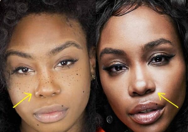 Sza’s Before And After Plastic Surgery Photos