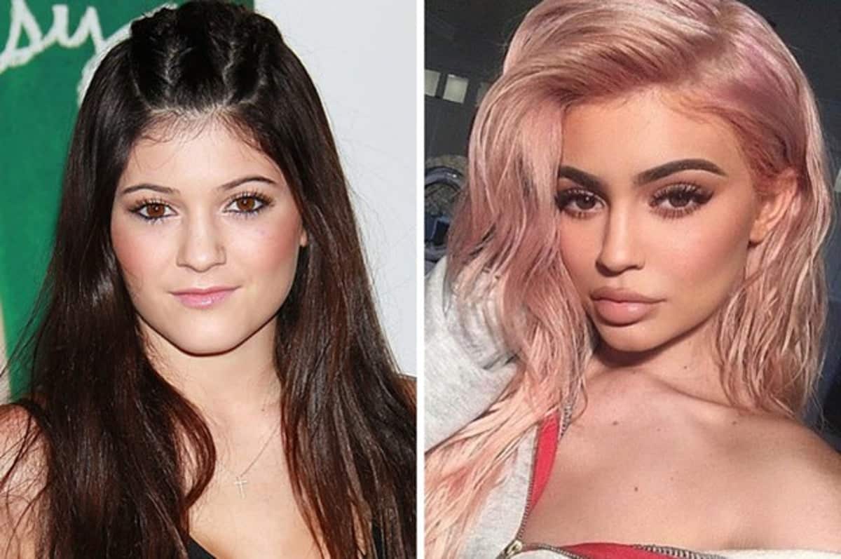 Kylie Jenner Has Finally Revealed Why She Got Lip Fillers