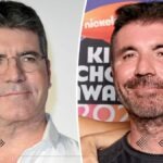 What Kind Of Plastic Surgery Did Simon Cowell Have?