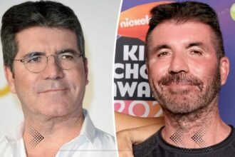 What Kind Of Plastic Surgery Did Simon Cowell Have?