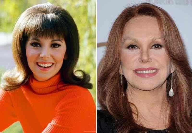 Marlo Thomas Plastic Surgery - Diversity News Magazine in 2022 | Celebrity plastic  surgery, Cosmetic surgery, Marlo thomas