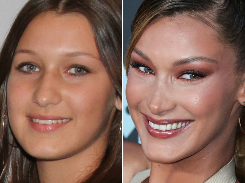 Bella Hadid Before Surgery What Else Do Plastic Surgeons Think She S Had Done