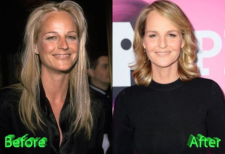 Did Helen Hunt Actually Get A Facelift?
