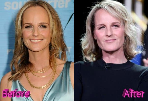 Helen Hunt Before And After Plastic Surgery