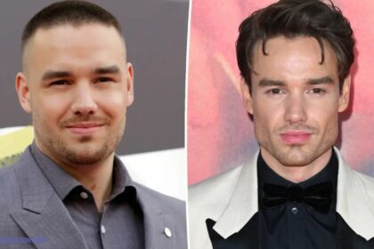 Liam Payne Face Surgery