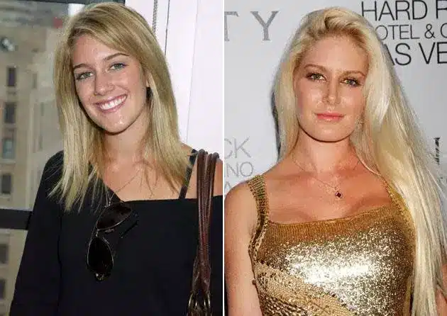 heidi face then and now