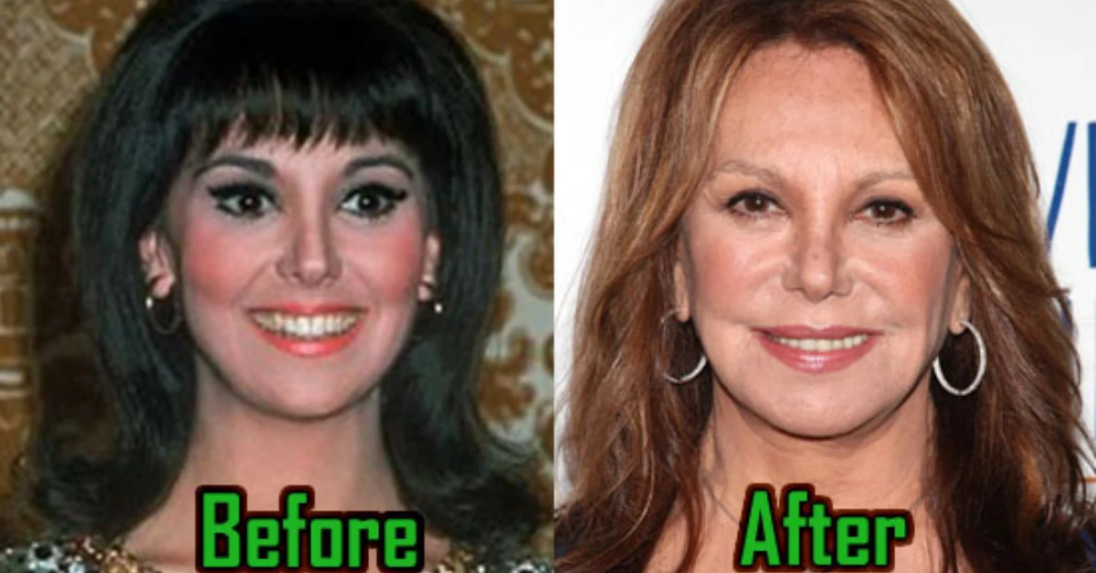 Marlo Thomas Plastic Surgery