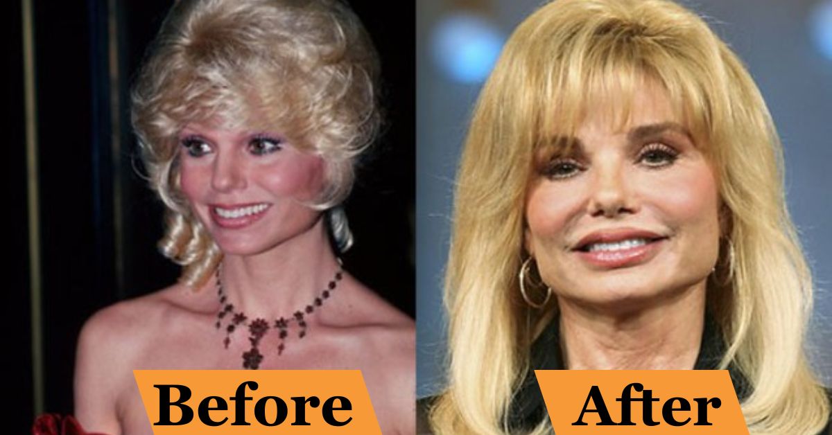 Loni Anderson Plastic Surgery